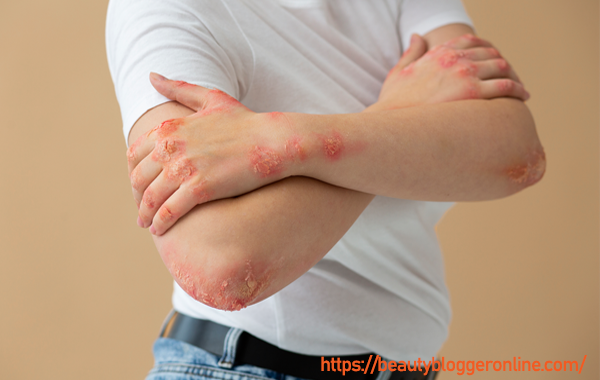 What-are-the-signs-and-symptoms-of-a-fungal-infection